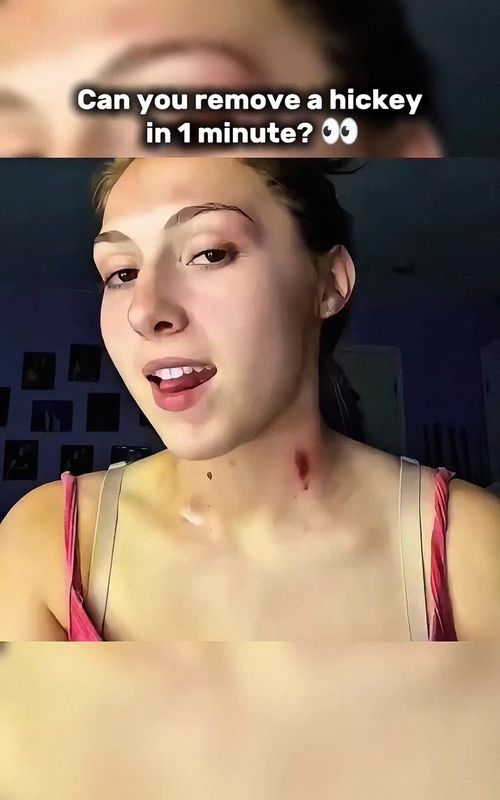 Can you remove a hickey in 1 minute? 👀.:#LifeHack #MythOrFact #Hickey #BeautyTi